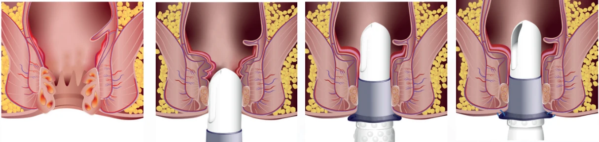 Sposób postępowania - hemoroidy i wypadanie błony śluzowej odbytnicy - grafika 1